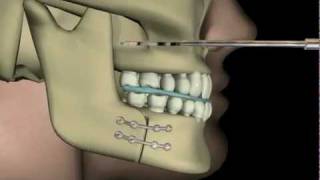 Çift Çene AmeliyatıUpper and Lower Jaw Surgery [upl. by Arretak]