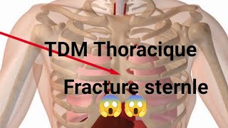 SCANNER THORACIQUE Fracture oblique déplacée sternale [upl. by Stormy]