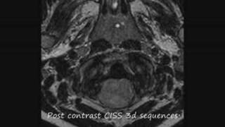 The plastic monster ependymoma how do you deal with this brain tumor in a six year old child [upl. by Ellette]