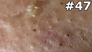 quot🔴 Satisfying Pimple Popping Extravaganza Watch the Most Satisfying Pops Everquot 47 [upl. by Notwal562]