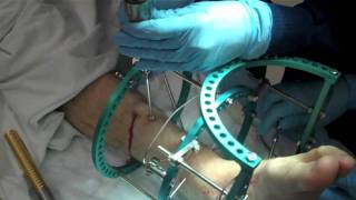 Removal of External Fixation [upl. by Sperling]