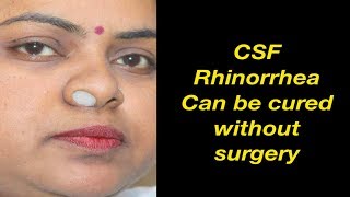 CSF Rhinorrhea case cured by Homeopathy Dr Ravi Singh [upl. by Imis803]