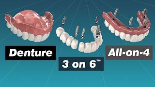 Alternative to Dentures Comparing Dentures Overdentures Allon4 and 3 on 6™ [upl. by Atillertse316]