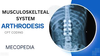 Arthrodesis CPT coding I Musculoskeletal System CPT Malayalam Explanation I CPT Malayalam I [upl. by Dnomra675]