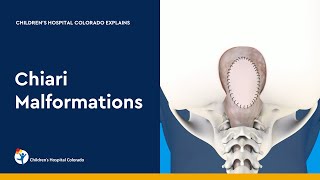 Chiari Malformation and Treatment [upl. by Delaryd]