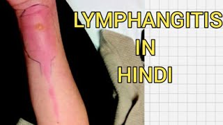 Acuteamp chronic lymphagitis in hindi  Cause  symptom [upl. by Sidra]