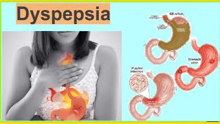 Dyspepsia  Functional Dyspepsia  Organic Dyspepsia Heart Burn Hindi  UrduTडिस्पेप्सिया [upl. by Arimaj138]