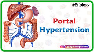 Portal hypertension USMLE Step 1  Etiology Clinical features Diagnosis and Treatment [upl. by Ayikur]