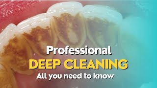 3 steps for a deep scaling and professional teeth cleaning [upl. by Anelah]