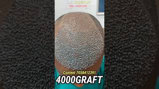 Hair treatment cost India hairtretment [upl. by Bryon]