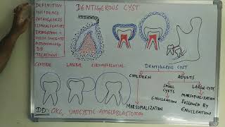 Dentigerous cyst [upl. by Wickham]