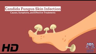 Candida Fungus Skin Infection Explained What You Need to Know [upl. by Acinor754]