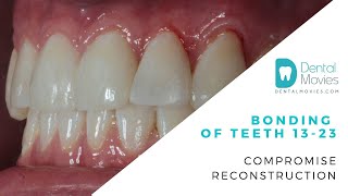 Bonding of teeth 13  23 Compromise reconstruction [upl. by Oderfigis]