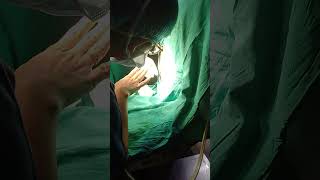 How to do spinal anesthesia before cesarean delivery [upl. by Uriel690]