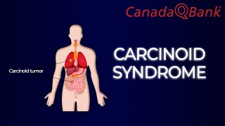 Carcinoid Syndrome [upl. by Reizarf]