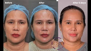 Fox eye thread lift  under eye Derma threads  and skin glow with Eladerm and skin boosters [upl. by Silberman]