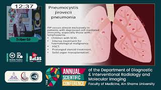 Pneumonia in immunocompromised pediatric patients [upl. by Jakob239]