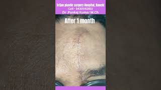 scar revision surgery Laser treatment of scar  Scar revision surgery in Ranchi scar Scarsurgery [upl. by Elyrpa267]