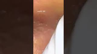 Pickel Ausdrücken Spa  Blackheads Akne amp Mitesser entfernen 🔴 33 [upl. by Airotahs819]