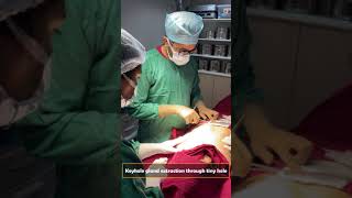 Awake gynecomastia surgery under local anesthesia Venkat Center Bangalore [upl. by Adnaugal655]