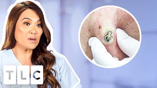 Top 5 Pimple Popping Moments From A 55YearOld Blackhead To Oozing Fistulas [upl. by Draner970]