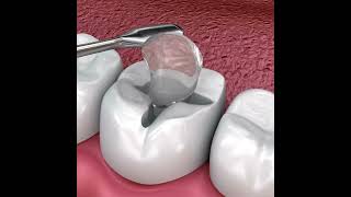 Teeth Inlays and Onlays  All Brite Dentistry inlay onlay dentist [upl. by Lenroc]