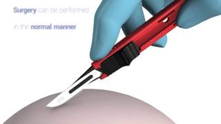 SwannMorton Disposable Retractable Scalpel [upl. by Leigh]