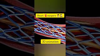 Heart 🫀surgery 🕵️‍♂️ 👩‍⚕️heart heartsurgerysurvivor  3d animation 3danimationsurgery [upl. by Kcirdderf]