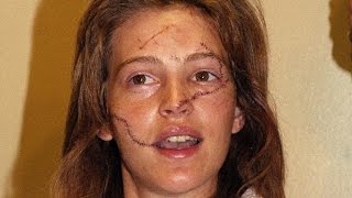 Former Model Who Was Slashed 30 Years Ago is Trying to Help Other Victims [upl. by Eng]