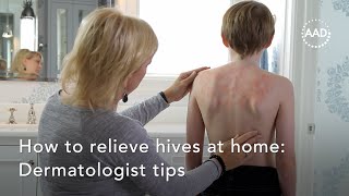 How to relieve hives at home [upl. by Mclaurin63]