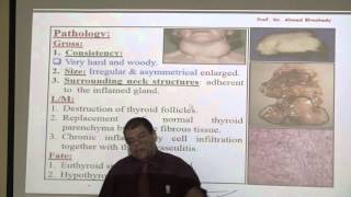 Pathology  NonNeoplastic Thyroid Lesions  Part 1 [upl. by Gilliette]