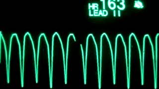 Arrêt cardiaque électrocardiogramme [upl. by Eetsirk]