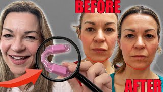 This device corrected my face shape and cured my jaw pain Oralift review [upl. by Rhoads302]