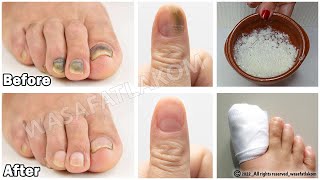 Do you suffer from nail fungus You have to do this  VERY IMPORTANT TIP [upl. by Tenney553]