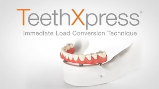 TeethXpress Immediate Load Conversion Technique [upl. by Lothar866]