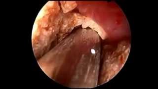 PCNL  Percutaneous Nephrolithotomy [upl. by Drexler]