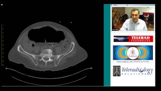 CT of Cecal Volvulus and Complications by Dr Arjun Kalyanpur [upl. by Oirotciv]