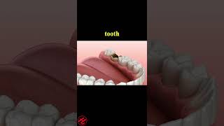 Periostitis tooth  Lump on Gum Above Tooth dentist dentalwellness [upl. by Lenssen]