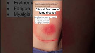 Clinical features of lyme disease [upl. by Lucille771]