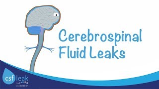 An Introduction to Cerebrospinal Fluid CSF Leaks [upl. by Gregrory998]