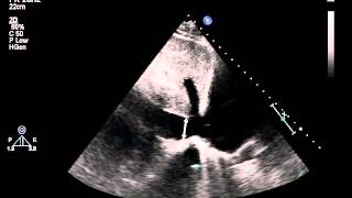 10 Subcostal view of the inferior vena cava IVC [upl. by Aken]