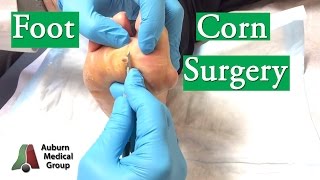 Foot Corn Surgery Treatment [upl. by Sager504]