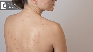 Tips to deal with Back Acne  Dr Swetha Sunny Paul [upl. by Naneik]