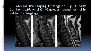 128 Intramedullary Spinal Tumor [upl. by Rahal]