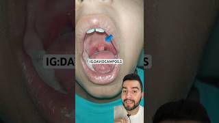 INFLAMACIÓN DE LA CAMPANA  UVULITIS [upl. by Earased]