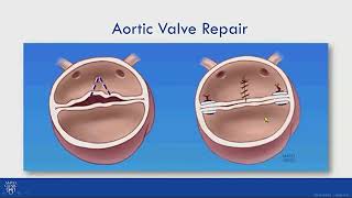 Valve Repair for Bicuspid Aortic Valve Related Aortic Regurgitation [upl. by Lula]