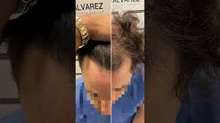 Trasplante capilar resultado  Injerto capilar  Hair transplant before after [upl. by Dorahs]