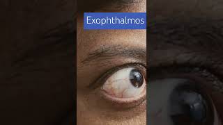 Exophthalmos imwell Exophthalmos [upl. by Emilia677]