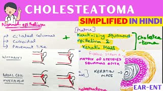 Cholesteatoma  Hindi  ENT [upl. by Elisabet]