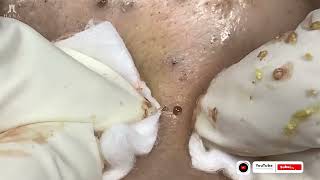 Big Cystic Acne Blackheads Extraction Blackheads amp Milia Whiteheads Removal Pimple Popping [upl. by Ahsiken]